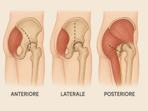 Illustrazione delle tecniche chirurgiche mini-invasive per la protesi d'anca