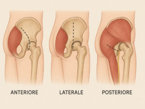 Illustrazione delle tecniche chirurgiche mini-invasive per la protesi d'anca
