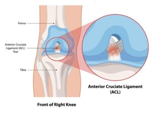 Anatomia del ginocchio con legamento crociato anteriore e menischi evidenziati